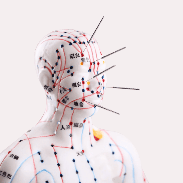 Акупунктура